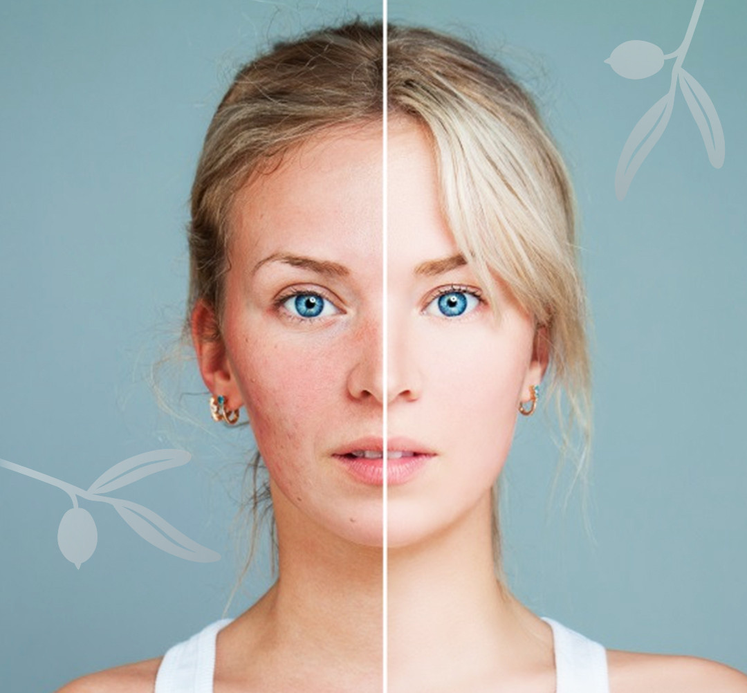 Šta je zapravo kuperoza?